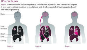 How to Treat and Prevent Sepsis in Nursing Home Residents
