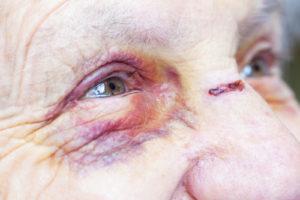 Alzheimer’s Abuse