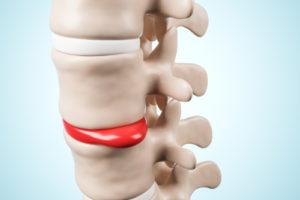 Spinal Injuries