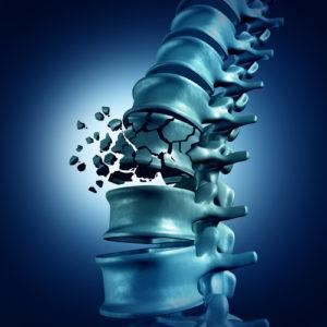 Compression Fracture