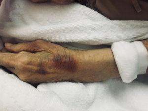 Intramuscular Bruise