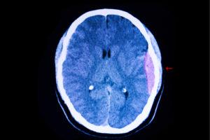 Can a Brain Bleed Heal Itself? | Bleeding of the Brain ...